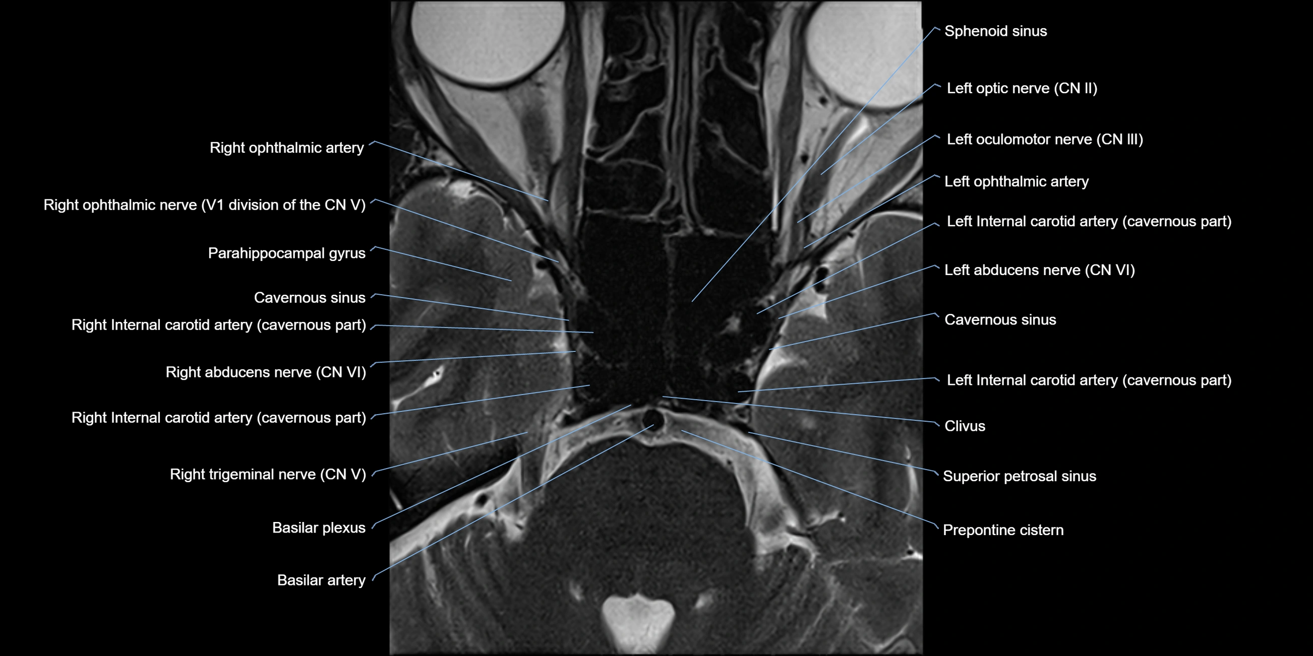 MRI cavernous sinus axial cross sectional 3T anatomy image-img-11001-00009.webp
